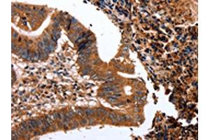 The image on the left is immunohistochemistry of paraffin-embedded Human colon cancer tissue using ABIN7128966(CLEC4A Antibody) at dilution 1/15, on the right is treated with fusion protein.