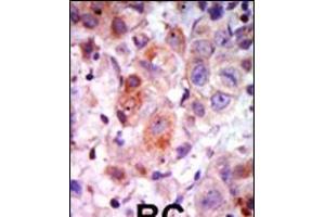 Formalin-fixed and paraffin-embedded human cancer tissue reacted with the primary antibody, which was peroxidase-conjugated to the secondary antibody, followed by AEC staining. (GRK2 antibody  (C-Term))