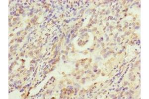 Immunohistochemistry of paraffin-embedded human lung cancer using ABIN7142261 at dilution of 1:100 (MRPS22 antibody  (AA 1-360))