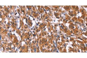 Immunohistochemistry of paraffin-embedded Human thyroid cancer tissue using TDP2 Polyclonal Antibody at dilution 1:40 (TDP2 antibody)