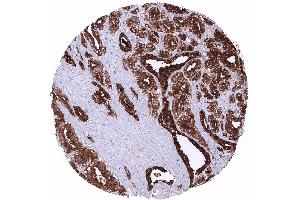 Prostate Adenocarcinoma Gleason 336 showing strong PSA positivity of tumor cells (Recombinant Prostate Specific Antigen antibody  (AA 150-250))