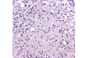 IHC analysis of RUNX1T1/ETO using anti-RUNX1T1/ETO antibody . (RUNX1T1 antibody  (AA 335-510))