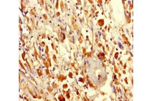 Immunohistochemistry of paraffin-embedded human melanoma using ABIN7165358 at dilution of 1:100 (FAM114A2 antibody  (AA 1-505))