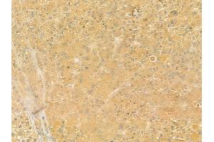 ABIN6257909 and ABIN6274573 at 1/100 staining human hepatocellular carcinoma by IHC-P.