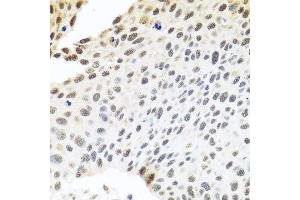Immunohistochemistry of paraffin-embedded human lung cancer using SKIV2L2 antibody. (MTR4 antibody  (AA 1-304))