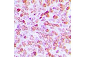 Immunohistochemical analysis of TBP staining in human prostate cancer formalin fixed paraffin embedded tissue section. (TBP antibody  (Center))