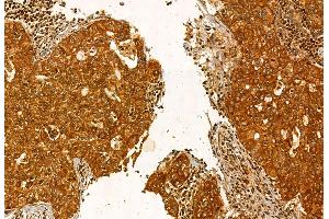 ABIN6264299 and ABIN6272885 at 1/100 staining Human lung cancer by IHC-P. (Pallidin antibody  (C-Term))