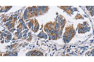 Immunohistochemistry of paraffin-embedded Human colon cancer tissue using NPPA Polyclonal Antibody at dilution 1:60 (NPPA antibody)