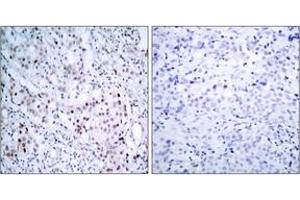 Immunohistochemistry analysis of paraffin-embedded human breast carcinoma, using c-Jun (Phospho-Ser63) Antibody. (C-JUN antibody  (AA 31-80))