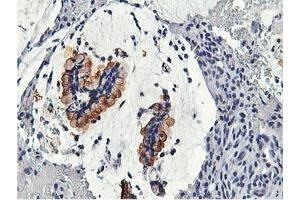 Immunohistochemical staining of paraffin-embedded Adenocarcinoma of Human colon tissue using anti-CAPN9 mouse monoclonal antibody. (Calpain 9 antibody)