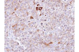 IHC-P Image Immunohistochemical analysis of paraffin-embedded CL1-0 xenograft , using Synaptophysin, antibody at 1:100 dilution. (Synaptophysin antibody  (C-Term))