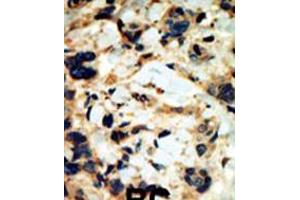 Formalin-fixed and paraffin-embedded human cancer tissue reacted with the primary antibody, which was peroxidase-conjugated to the secondary antibody, followed by DAB staining. (SGK2 antibody  (C-Term))