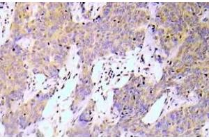 Immunohistochemistry (IHC) analyzes of NFkB-p65 pAb in paraffin-embedded human lung adenocarcinoma tissue. (NF-kB p65 antibody)