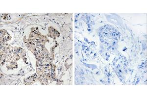 Peptide - +Immunohistochemistry analysis of paraffin-embedded human breast carcinoma tissue using BLK antibody. (BLK antibody  (Internal Region))