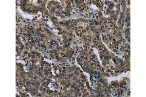 Immunohistochemistry of Human liver cancer using FTO Polyclonal Antibody at dilution of 1:60