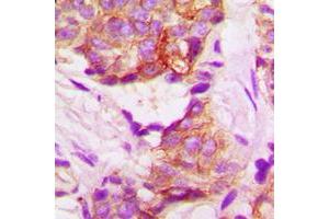 Immunohistochemical analysis of TACSTD2 staining in human lung cancer formalin fixed paraffin embedded tissue section. (TACSTD2 antibody  (Center))