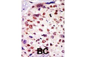 Formalin-fixed and paraffin-embedded human breast cancer tissue reacted with BAI1 polyclonal antibody  , which was peroxidase-conjugated to the secondary antibody, followed by AEC staining. (BAI1 antibody  (C-Term))