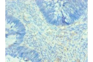 Immunohistochemical of paraffin-embedded human breast cancer using ABIN7143609 at dilution of 1:200 (Fetuin A antibody)