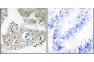 Immunohistochemistry analysis of paraffin-embedded human colon carcinoma tissue, using CIDEC Antibody. (CIDEC antibody  (AA 189-238))