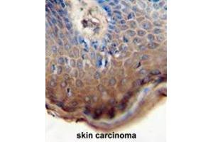 TJAP1 antibody (N-term) immunohistochemistry analysis in formalin fixed and paraffin embedded human skin carcinoma followed by peroxidase conjugation of the secondary antibody and DAB staining. (TJAP1 antibody  (N-Term))