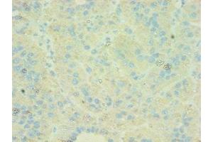 Immunohistochemistry of paraffin-embedded human liver cancer using ABIN7146169 at dilution of 1:100 (C4BPB antibody  (AA 18-252))