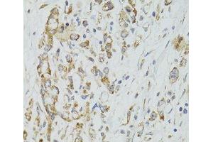Immunohistochemistry of paraffin-embedded Human gastric cancer using DICER1 Polyclonal Antibody at dilution of 1:100 (40x lens). (DICER1 antibody)