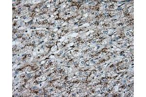 Immunohistochemical staining of paraffin-embedded Carcinoma of liver tissue using anti-ERCC1 mouse monoclonal antibody. (ERCC1 antibody)