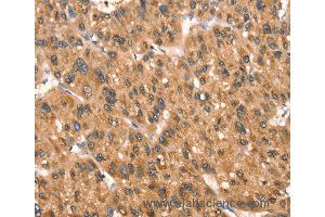 Immunohistochemistry of Human colon cancer using DAP Polyclonal Antibody at dilution of 1:40