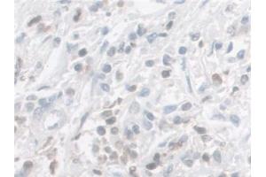 Detection of GAL9 in Human Prostate cancer Tissue using Polyclonal Antibody to Galectin 9 (GAL9) (Galectin 9 antibody  (AA 1-323))
