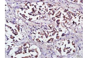 Paraformaldehyde-fixed, paraffin embedded human lung cancer, Antigen retrieval by boiling in sodium citrate buffer (pH6) for 15min, Block endogenous peroxidase by 3% hydrogen peroxide for 30 minutes, Blocking buffer (normal goat serum) at 37°C for 20min, Antibody incubation with RNF138 Polyclonal Antibody, Unconjugated  at 1:500 overnight at 4°C, followed by a conjugated secondary and DAB staining. (RNF138 antibody  (AA 90-130))