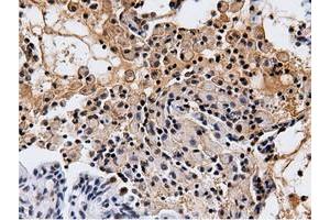 Immunohistochemical staining of paraffin-embedded Adenocarcinoma of Human breast tissue using anti-NT5DC1 mouse monoclonal antibody. (NT5DC1 antibody)