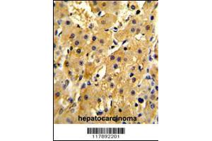 Formalin-fixed and paraffin-embedded human hepatocarcinoma reacted with HPD Antibody (N-term), which was peroxidase-conjugated to the secondary antibody, followed by DAB staining. (HPD antibody  (N-Term))