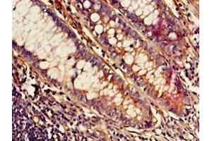 Immunohistochemistry of paraffin-embedded human colon cancer using ABIN7159128 at dilution of 1:100 (MED23 antibody  (AA 1014-1368))