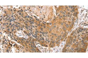 Immunohistochemistry of paraffin-embedded Human esophagus cancer using STX10 Polyclonal Antibody at dilution of 1:45 (Syntaxin 10 antibody)