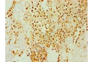 Immunohistochemistry of paraffin-embedded human breast cancer using ABIN7149658 at dilution of 1:100 (Seladin 1 antibody  (AA 227-516))