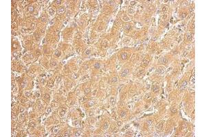 IHC-P Image UGDH antibody detects UGDH protein at cytosol on human hepatoma by immunohistochemical analysis. (UGDH antibody)