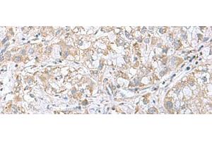 Immunohistochemistry of paraffin-embedded Human liver cancer tissue using CGB5 Polyclonal Antibody at dilution of 1:55(x200)