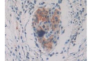 Detection of PKIg in Human Pancreatic cancer Tissue using Polyclonal Antibody to Protein Kinase Inhibitor Gamma (PKIg) (PKIG antibody  (AA 1-76))