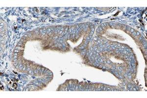 ABIN6279733 at 1/100 staining Human cervical cancer tissue by IHC-P. (RAB24 antibody  (Internal Region))