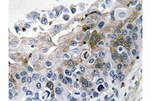 Immunohistochemistry analysis of IL-1B Antibody in paraffin-embedded human lung carcinoma tissue.