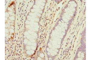 Immunohistochemistry of paraffin-embedded human colon cancer using ABIN7172974 at dilution of 1:100 (TMED1 antibody  (AA 35-190))