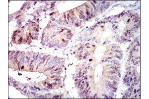 Figure5: Immunohistochemical analysis of paraffin-embedded colon cancer tissues using PBK mouse mAb with DAB staining. (PBK antibody)