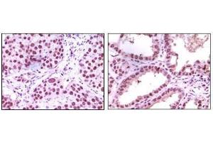 Immunohistochemical analysis of paraffin-embedded human lung carcinoma (left) and kidney carcinoma (right), showing nuclear localization using LSD1 mouse mAb with DAB staining. (LSD1 antibody)