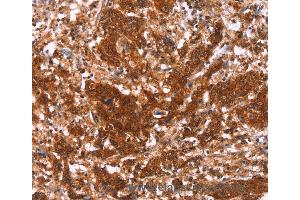 Immunohistochemistry of Human gastric cancer using HAS1 Polyclonal Antibody at dilution of 1:30 (HAS1 antibody)