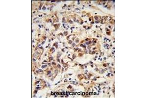 Formalin-fixed and paraffin-embedded human breast carcinoma reacted with SPRR1B Antibody (C-term), which was peroxidase-conjugated to the secondary antibody, followed by DAB staining. (SPRR1B antibody  (C-Term))