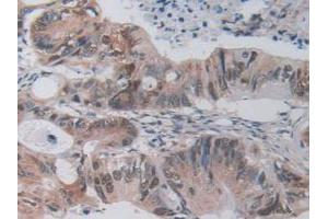 IHC-P analysis of Mouse Rectum Cancer Tissue, with DAB staining.