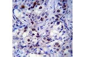 Rb antibody immunohistochemistry analysis in formalin fixed and paraffin embedded human breast carcinoma. (Retinoblastoma Protein (Rb) antibody  (AA 586-615))