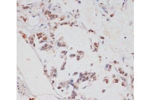 Immunohistochemistry of paraffin-embedded Human gastric cancer using HTATSF1 Polyclonal Antibody at dilution of 1:100 (40x lens).