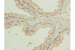 Immunohistochemistry of paraffin-embedded human prostate cancer using ABIN7175806 at dilution of 1:100 (WDR91 antibody  (AA 1-747))