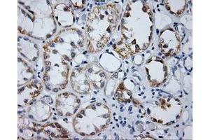 Immunohistochemical staining of paraffin-embedded Carcinoma of prostate tissue using anti-LIPG mouse monoclonal antibody. (LIPG antibody)